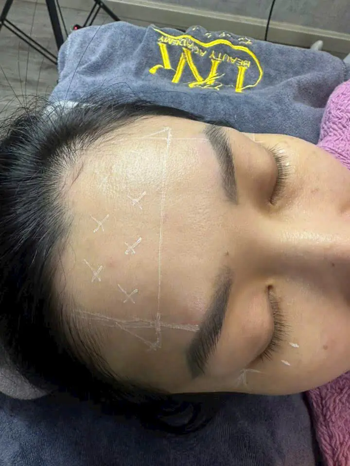 Cân chỉnh Trán