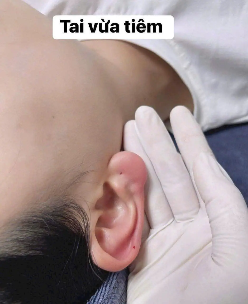 Tiêm tai tài lộc